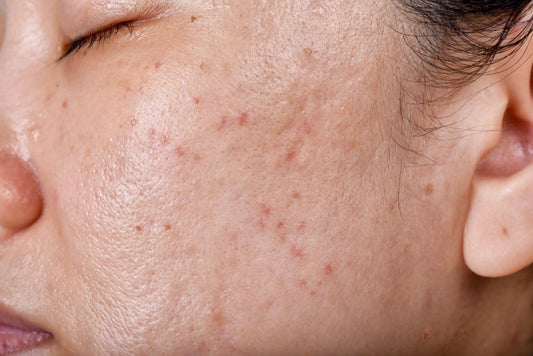 6 COMMON CAUSES OF BREAKOUTS AND HOW TO AVOID THEM